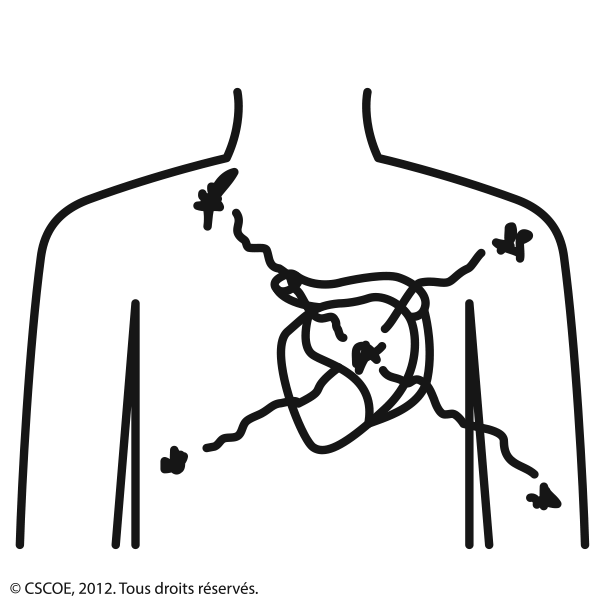 Crise cardiaque_NB