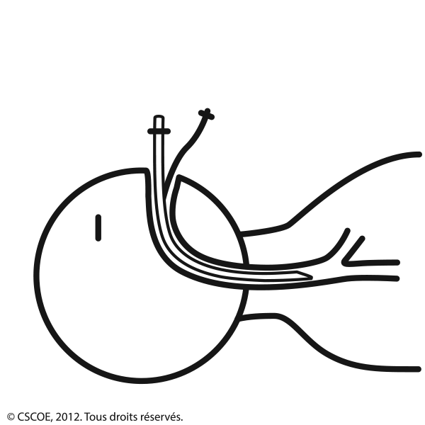 Intubation_NB